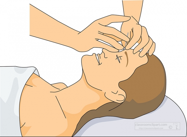 Acupuncture Treatment of the Forehead